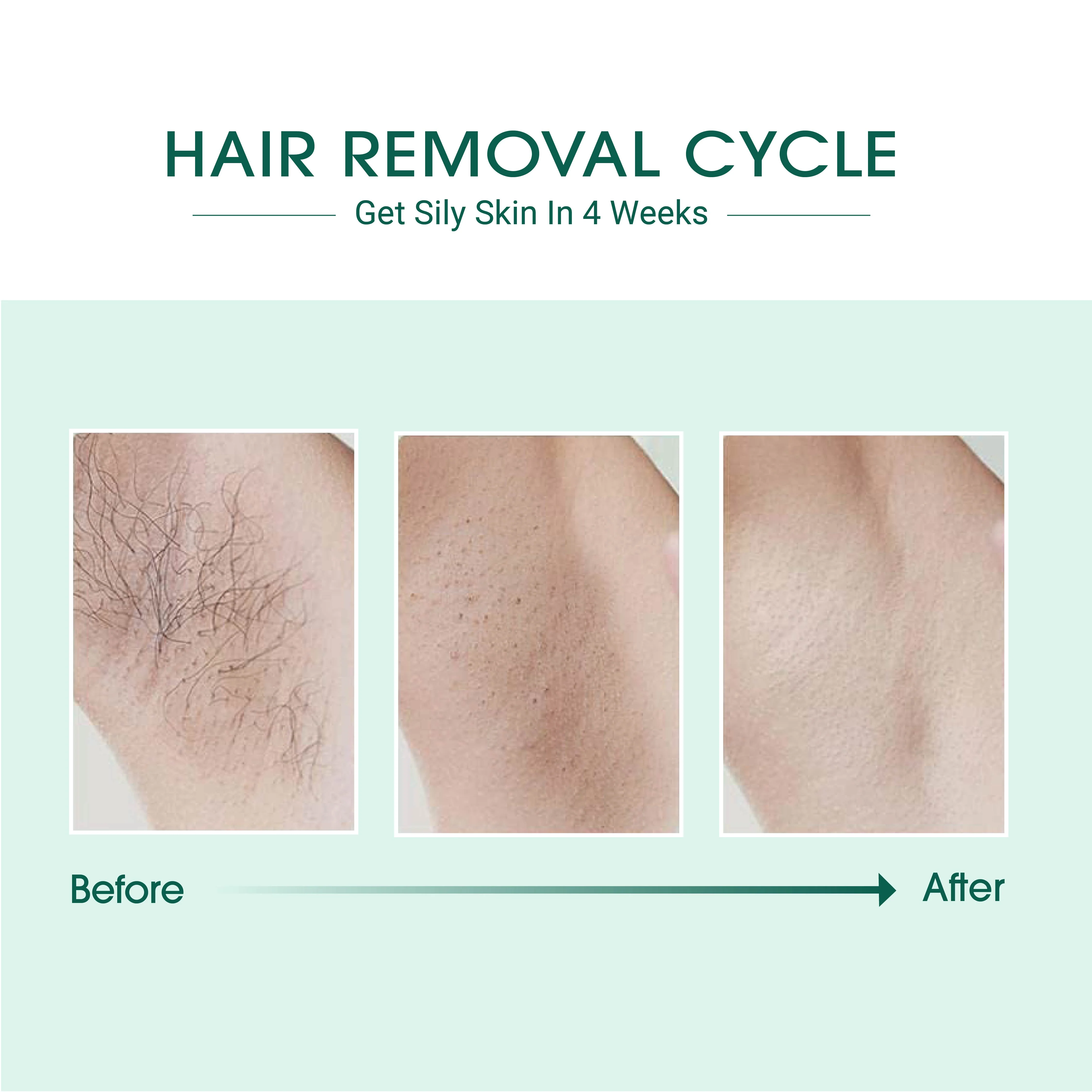 Laser IPL Hair Removal - Image 6